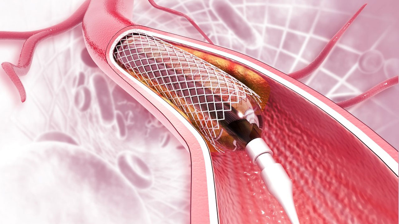 ২৩ ধরনের হার্টের রিংয়ের দাম কমলো