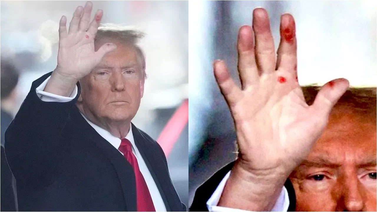 ট্রাম্পের হাতে রহস্যময় দাগ, যৌনরোগ নয় তো?