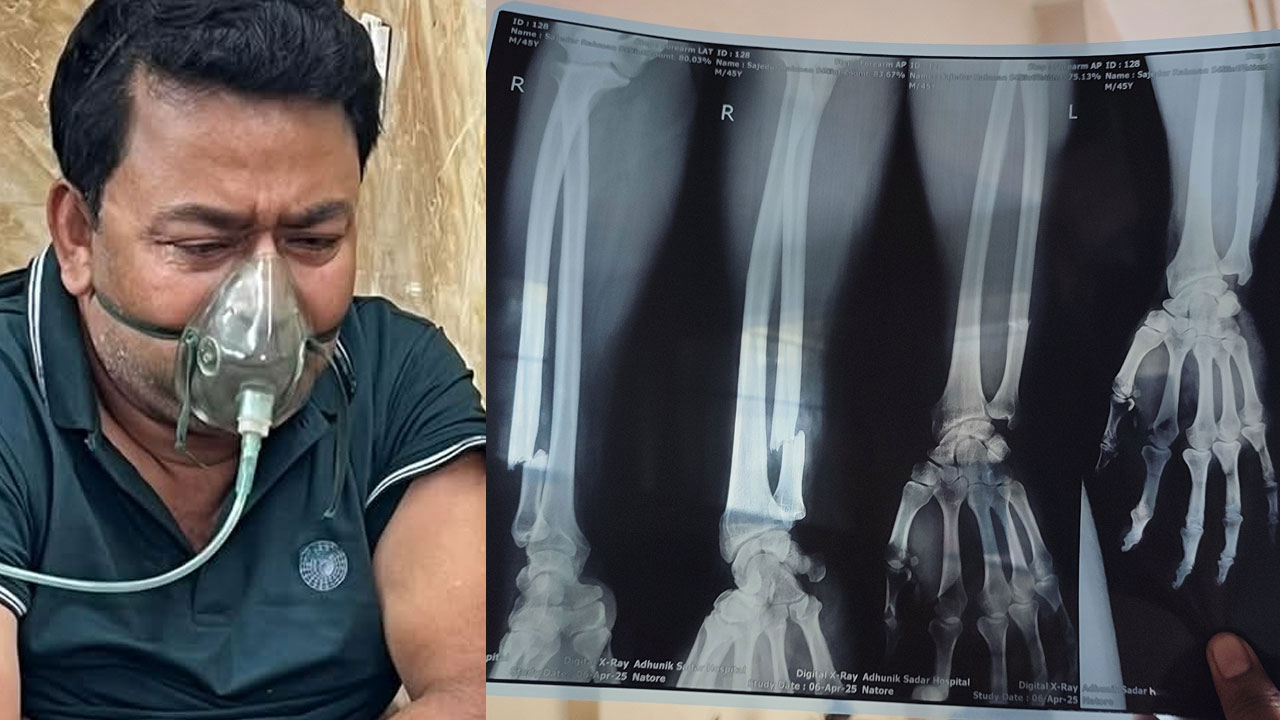 সাংবাদিকের হাত ভেঙে দেওয়ার ঘটনায় বিএনপি নেতাসহ গ্রেপ্তার ২
