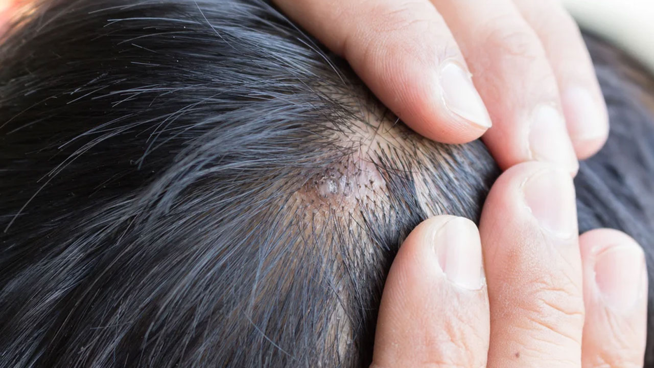 মাথার ত্বকে ব্রণ হলে কী করবেন?