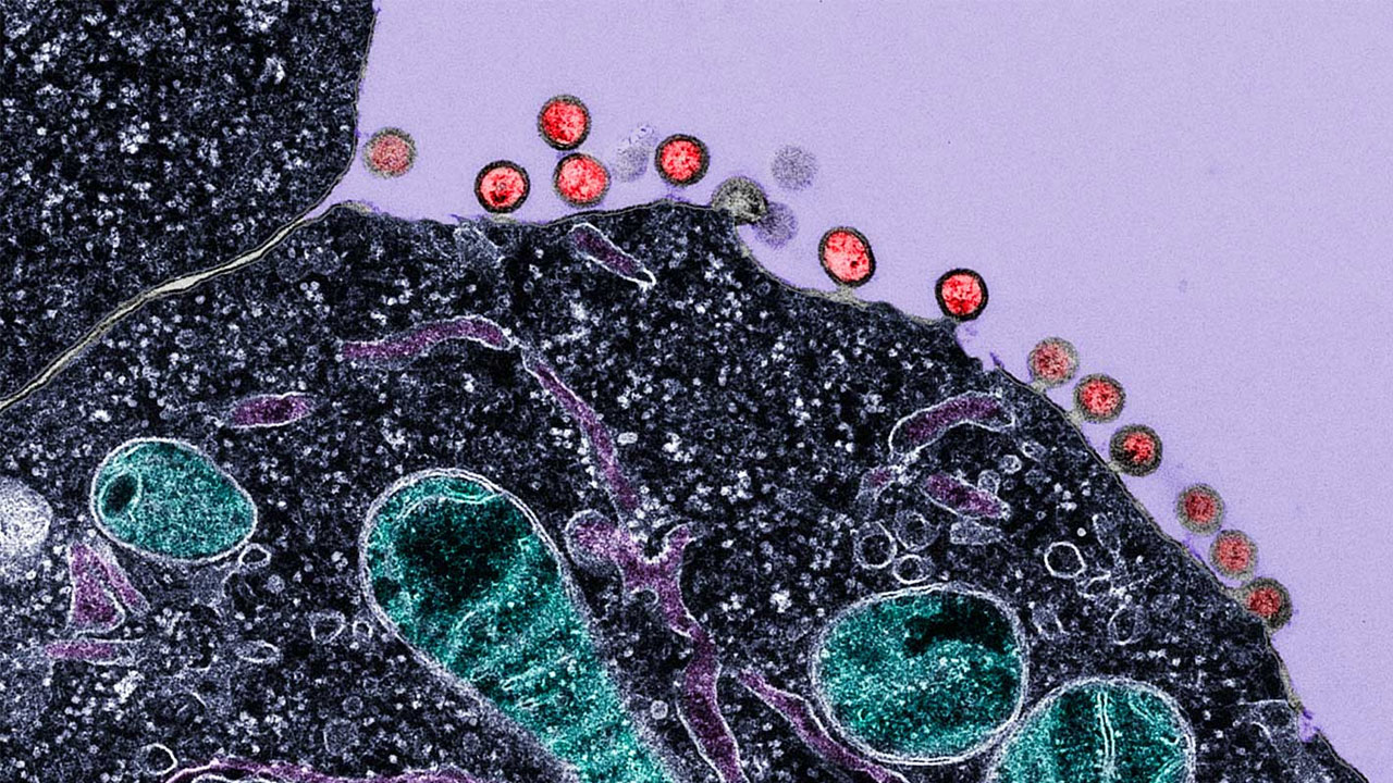 এইডস চিকিৎসায় আশার আলো, ১৮ মাস ওষুধ না খেয়েও সুস্থ ৭ রোগী