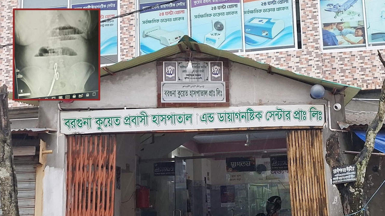 রোগীর পেটে কাঁচি রেখেই সেলাই, ৭ মাস পর অপসারণ