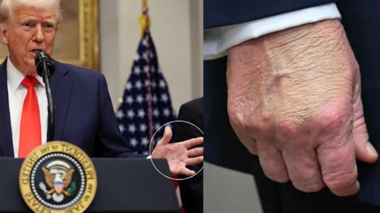 ট্রাম্পের হাতে কালশিটে দাগ, জটিল রোগে আক্রান্ত তিনি?