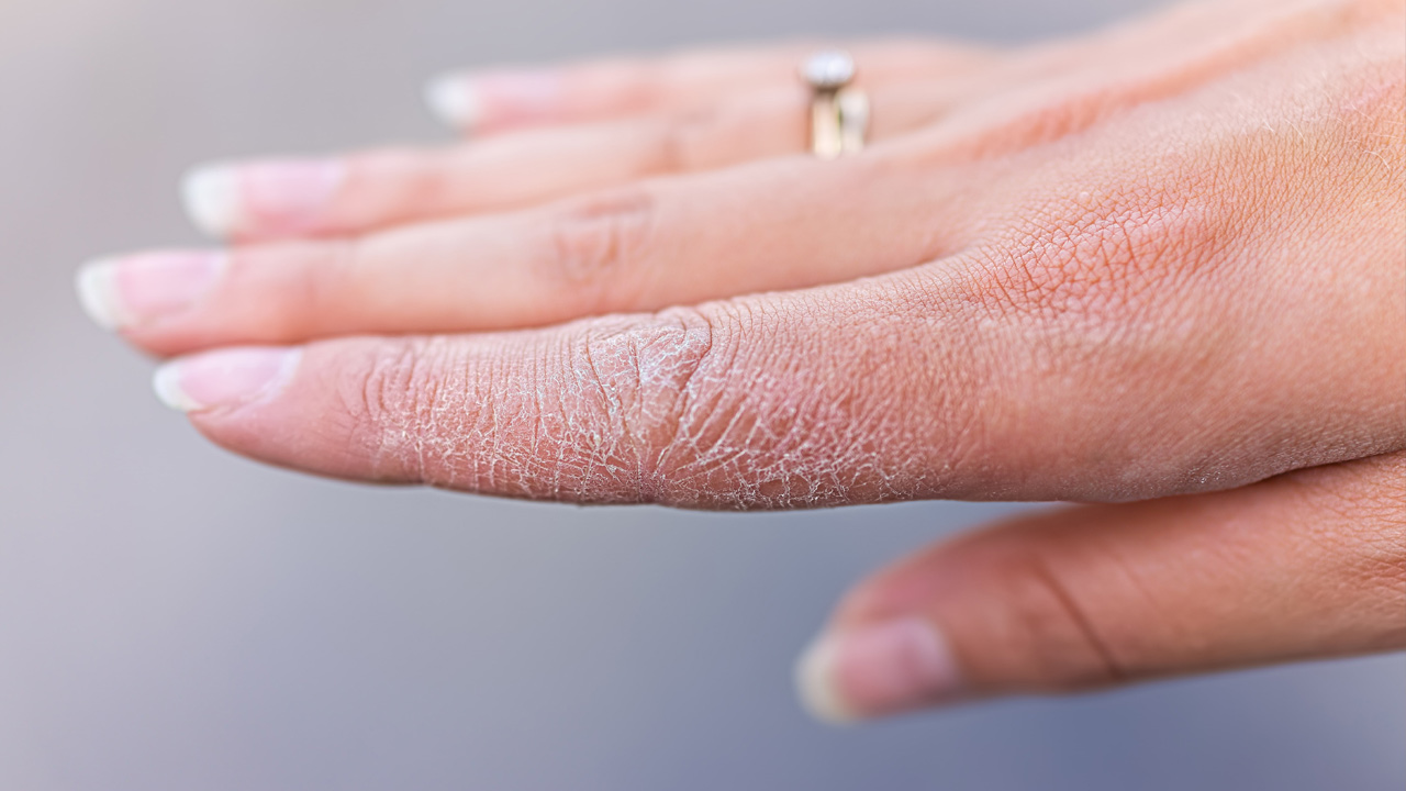 শরীরের মরা চামড়া উঠে গেলে অজু ভাঙবে?