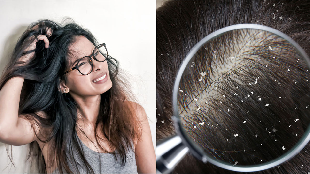 মাথাভর্তি খুশকি? সমস্যা নিয়ে ৫ ভুল ধারণা ভাঙুন আজই