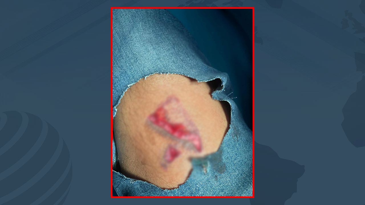 পল্লবীতে ককটেল বিস্ফোরণে পুলিশের এএসআই আহত