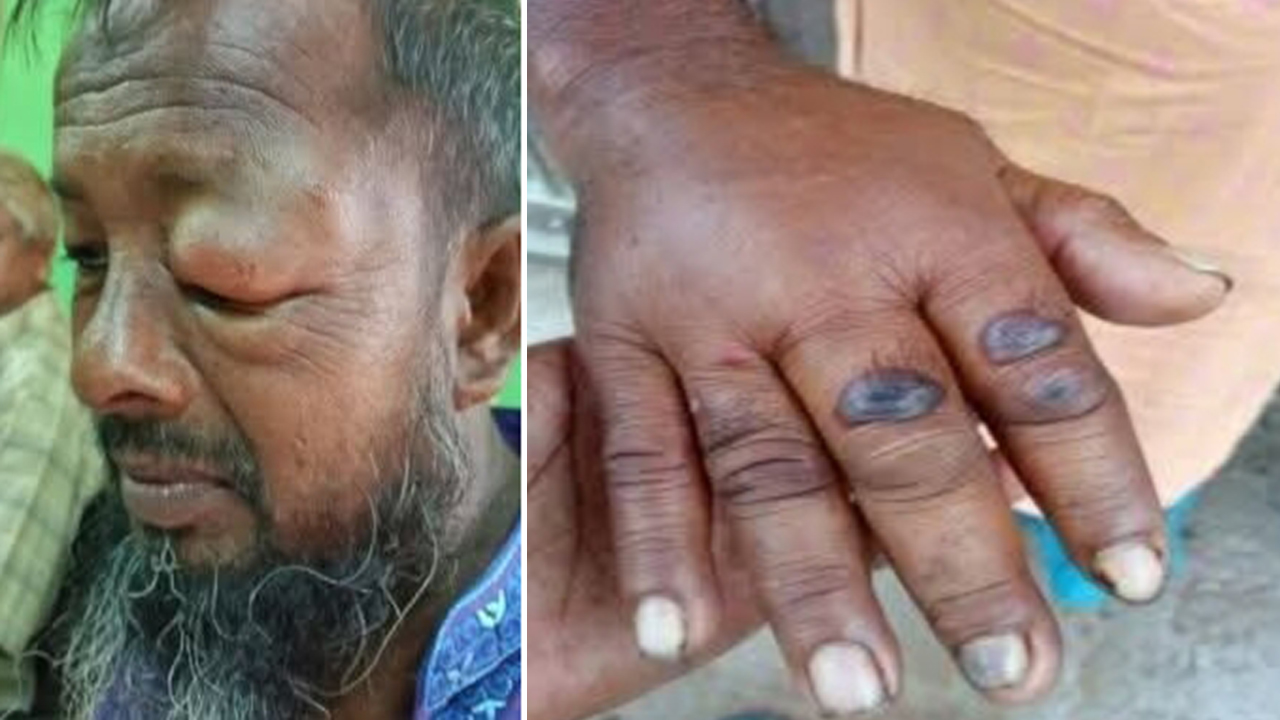 সুন্দরগঞ্জে ১১ জনের শরীরে অ্যানথ্রাক্স শনাক্ত, হাসপাতালে ভর্তি ৫